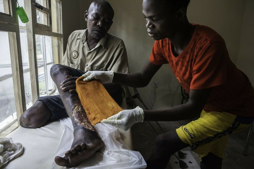 Treating a patient's leg wound at Masanga Hospital's wound clinic.